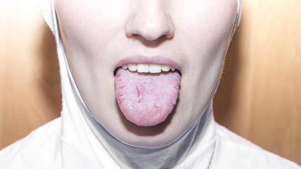 Síntomas y tratamiento de la Glositis (la enfermedad de la lengua hinchada)