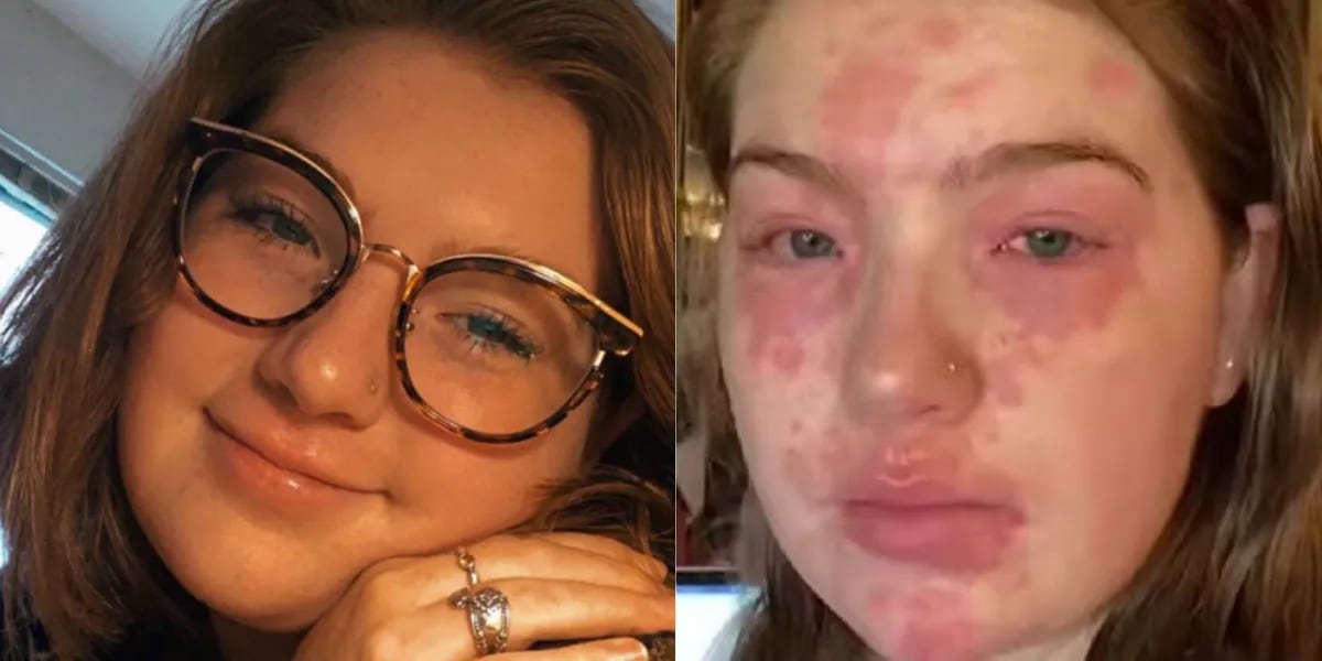 22-year-old finds out she’s allergic to her boyfriend and doctors can’t find the solution: ‘It’s very frustrating’