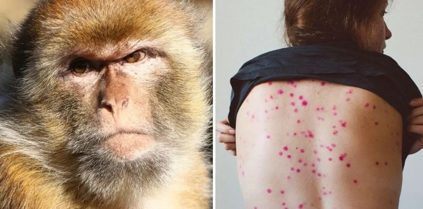 Confirmaron el segundo caso de viruela de mono en Argentina