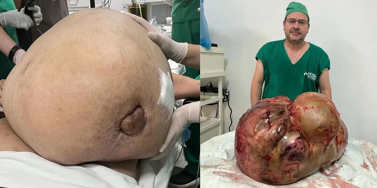 Vivió durante cinco años con un tumor de 45 kilos y finalmente se lo sacaron: "El más grande que he operado"