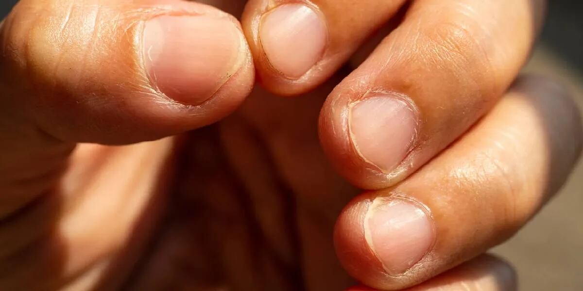 Onicofagia: cuáles son los peligros de morderse las uñas