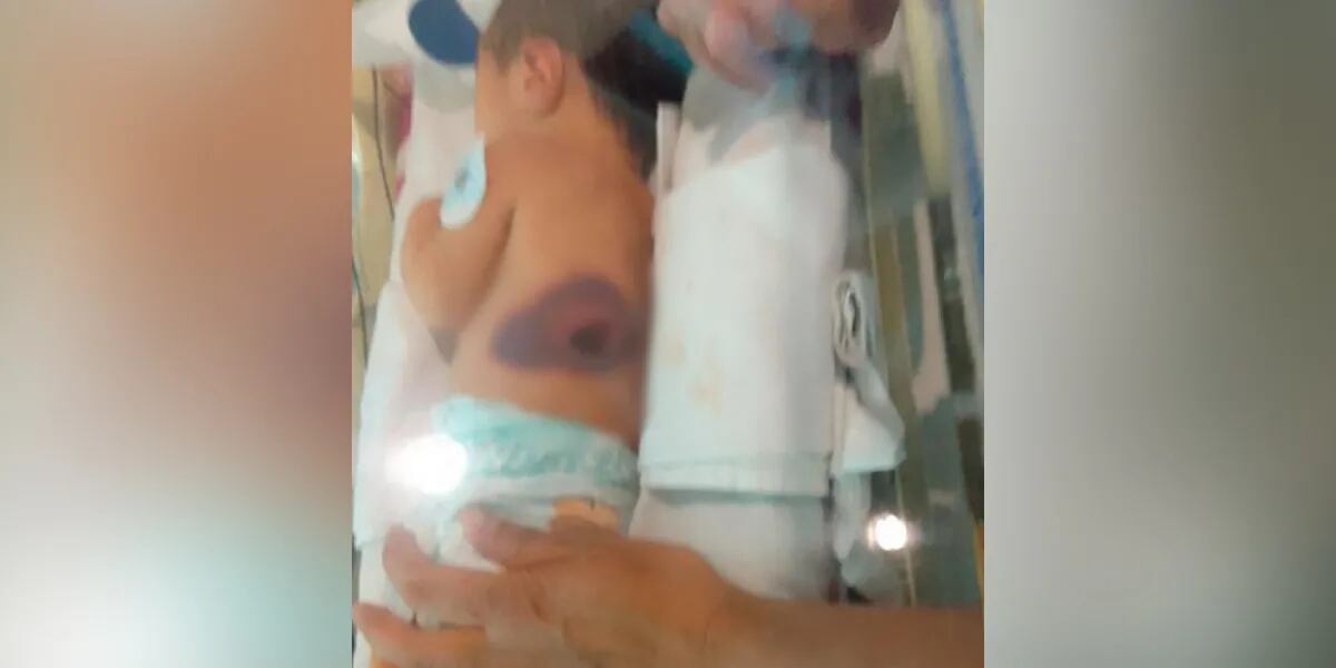 La mamá de una nena que quedó con graves secuelas en el hospital de Córdoba mostró fotos: “Se produjo una necrosis”