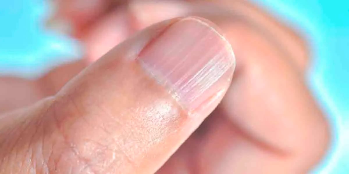 Uñas moradas: por qué se ponen de ese color sin haber sufrido un golpe