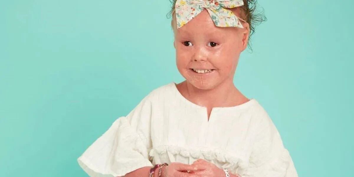Una nena de 6 años tiene una rara enfermedad de la piel y se lanzó como modelo: “No puedes evitar amarla”