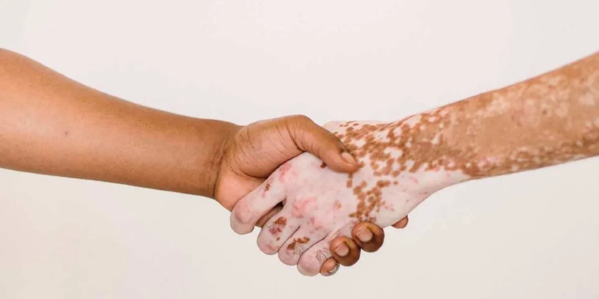 Día Mundial del Vitiligo: por qué se conmemora hoy 25 de junio