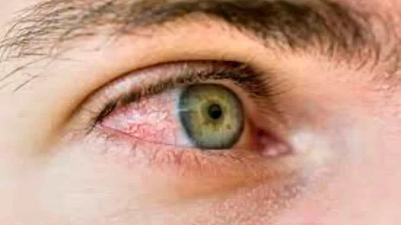 Los ojos resecos podrían indicar que la tiroides está afectando la vista