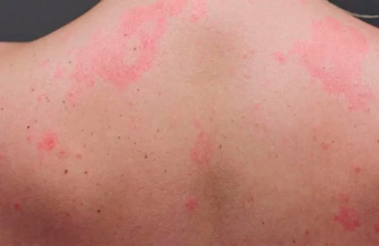 Coronavirus: una erupción en la piel puede ser el primer síntoma de contagio