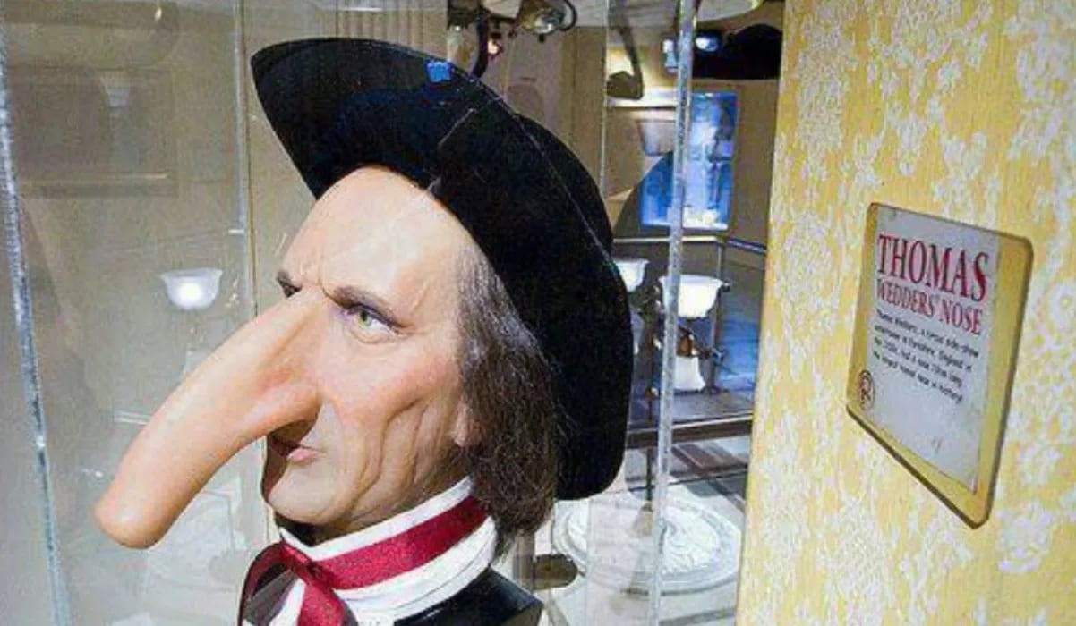 El doloroso calvario de Thomas Wedders, el hombre con la nariz más grande del mundo