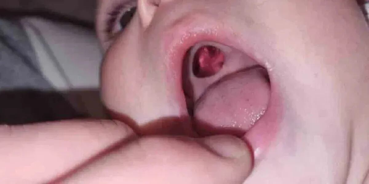 Llevó a urgencias a su bebé al verle un “agujero” en su boca y las enfermeras descubrieron que se trataba de un error de la mamá: “Una vergúenza”