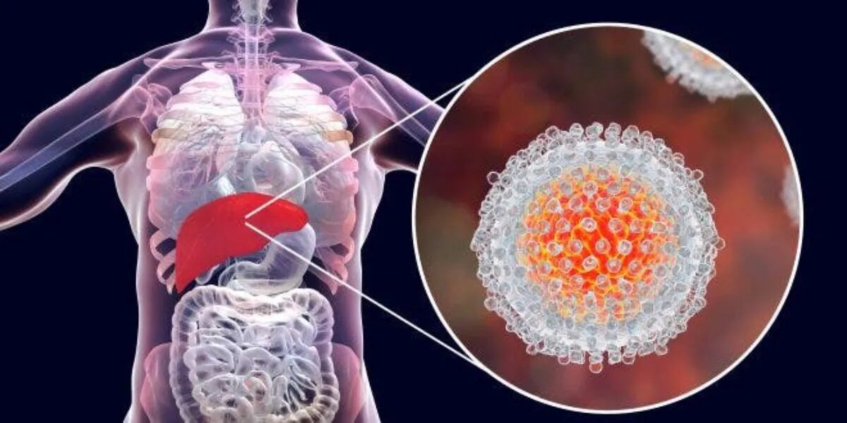Hepatitis: qué es, cuáles son sus síntomas y cómo tratar la enfermedad