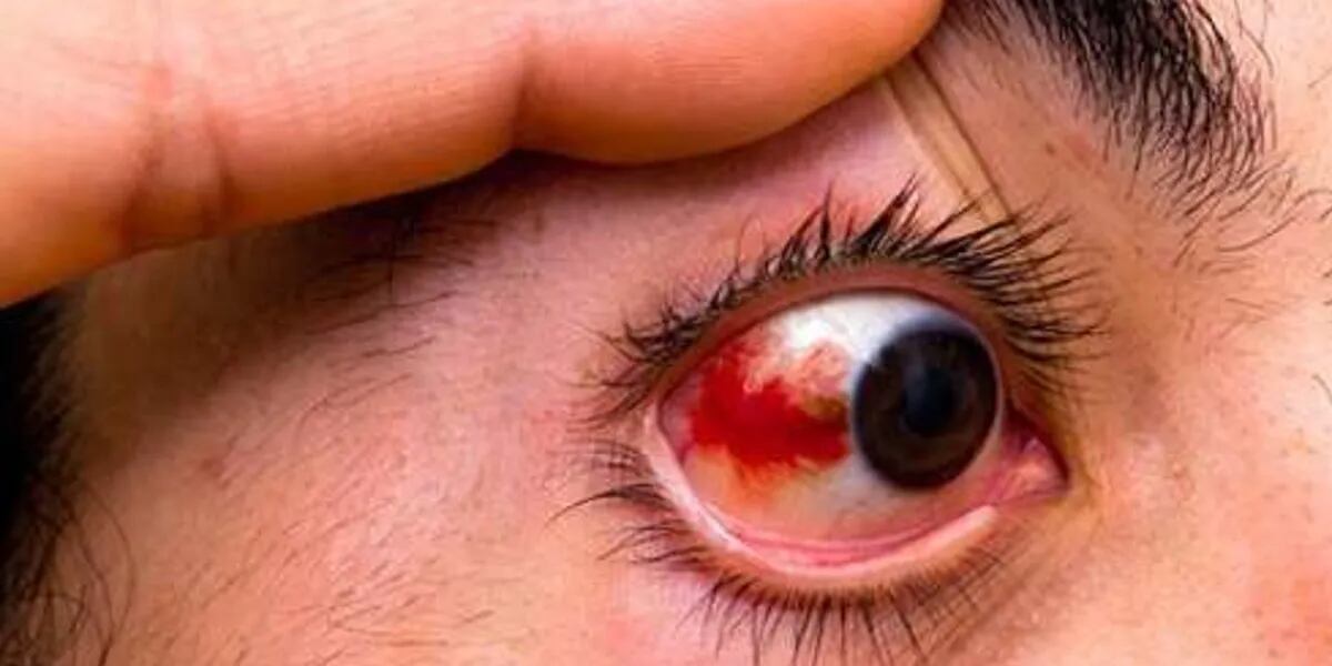 Los 8 signos del virus mortal que provoca sangrado ocular y mata al 30% de los pacientes