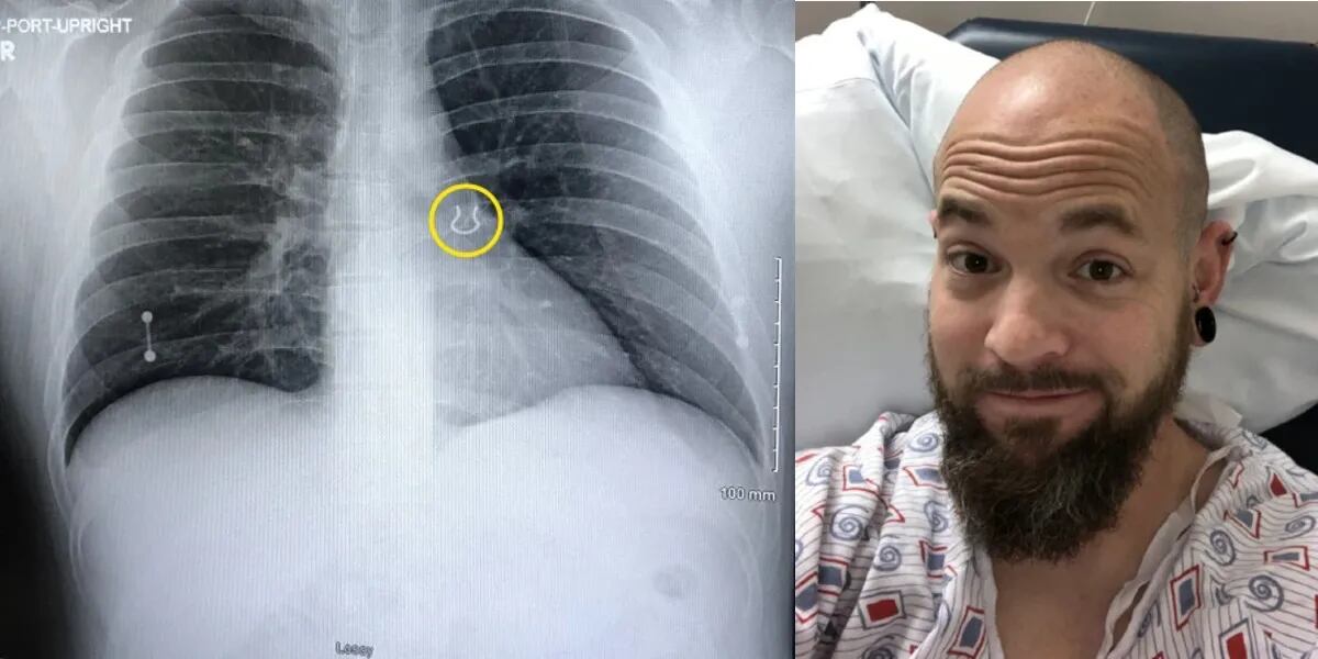 Perdió el piercing de la nariz hasta que 5 años después le hicieron una radiografía: “Mi esposa quedó estupefacta"