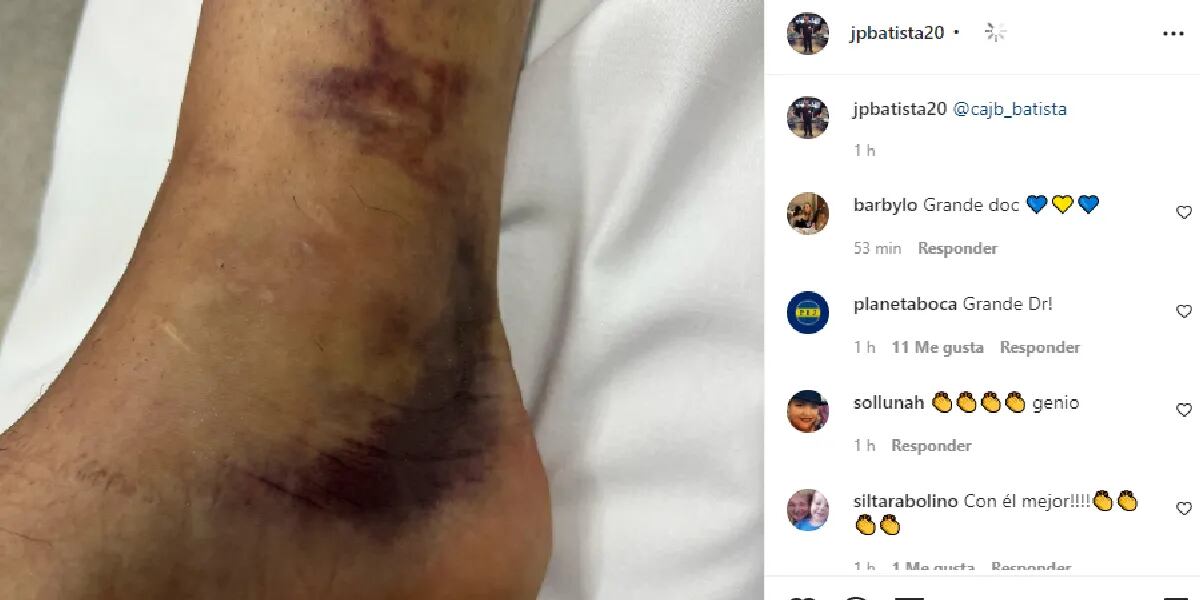 Mostraron cómo quedó el tobillo de Exequiel Zeballos tras la brutal patada que sufrió en el partido contra Agropecuario