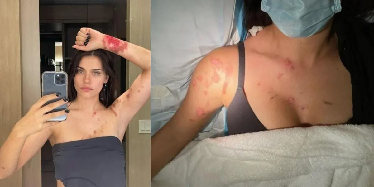 “Quemaduras de segundo grado”: Eva de Dominici mostró fotos de su cuerpo tras sufrir un accidente