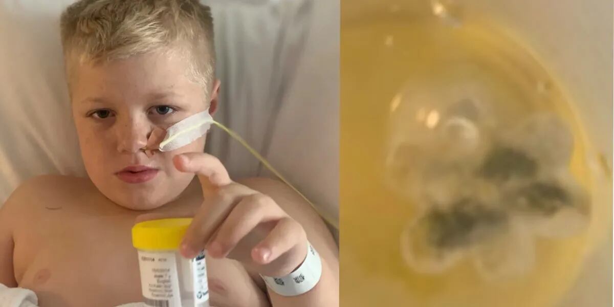 Un nene de 8 años tosió durante cinco años, los médicos no encontraron la razón, lo operaron y le sacaron un juguete de plástico de la garganta