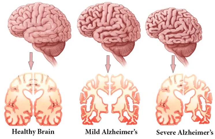 El Alzheimer puede empezar a los 20 o 30 años, según un estudio