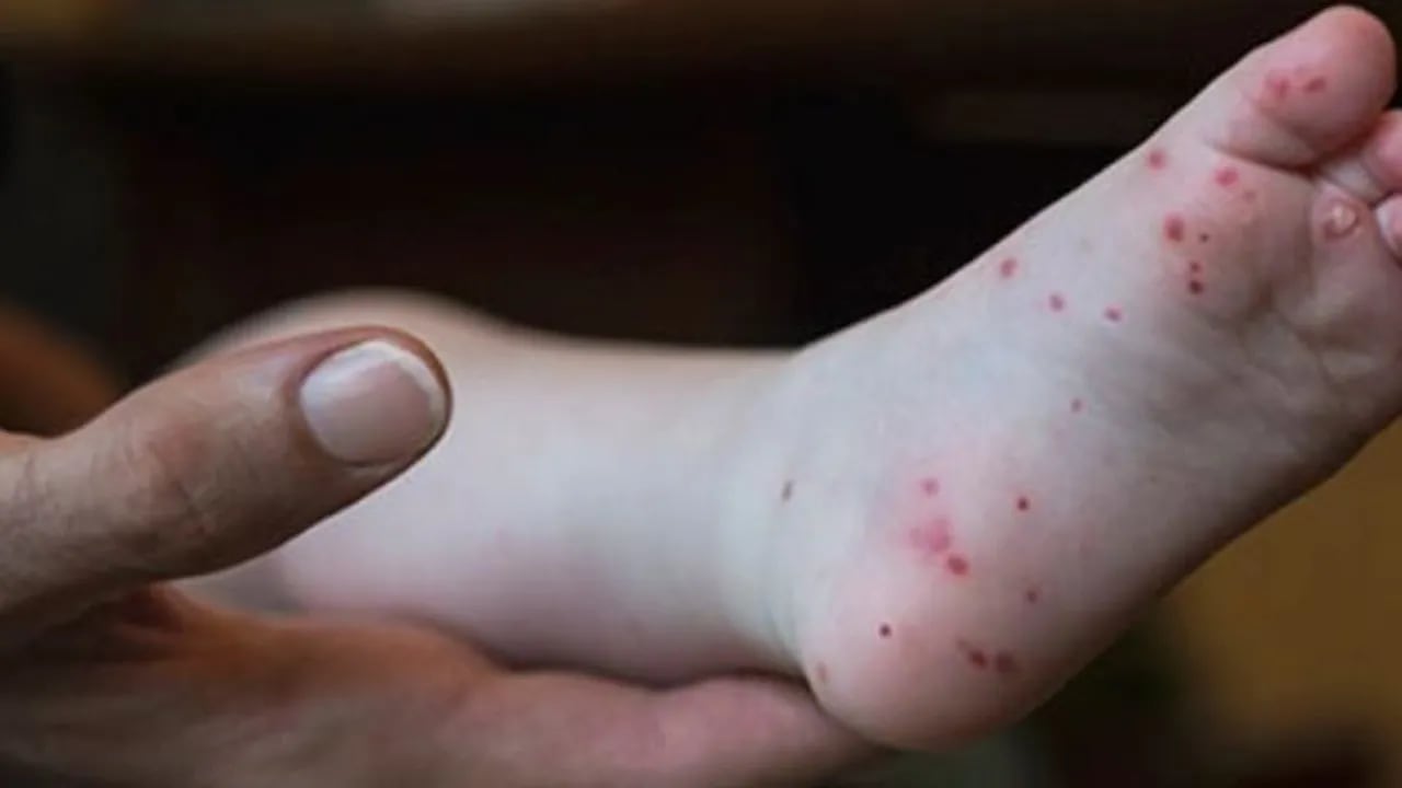 Enfermedad de manos, pies y boca: de qué se trata y cuáles son sus síntomas