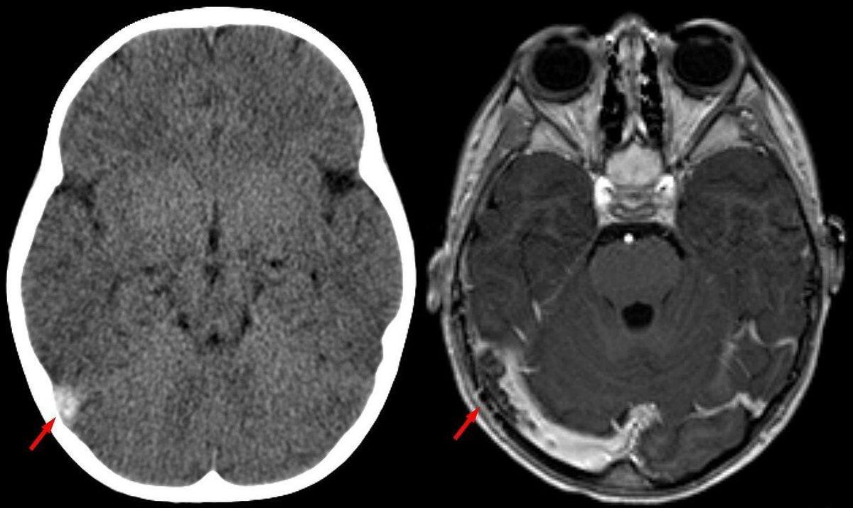 Que Es Una Trombosis Trombosis Venosa Cerebral La Trombosis Venosa Images And Photos Finder