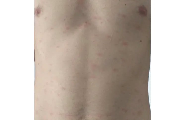 Coronavirus | 5 lesiones importantes que puede generar en la piel